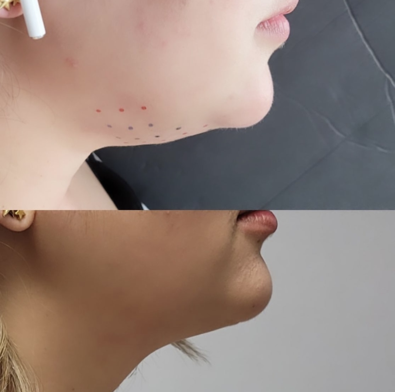 kybella Patient 1