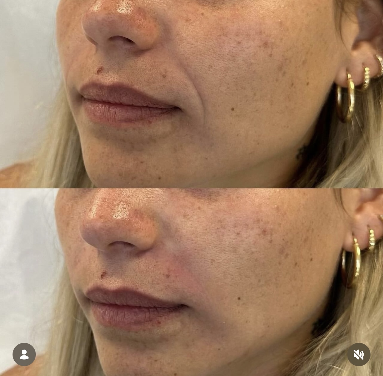 nasolabial-fold-correction Patient 2