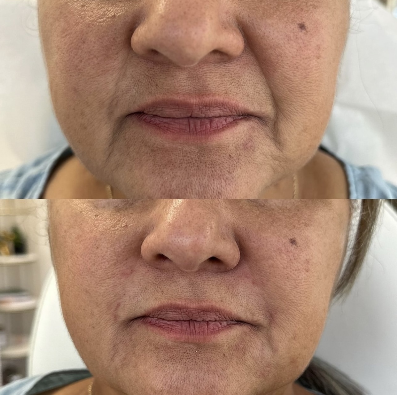 nasolabial-fold-correction Patient 1