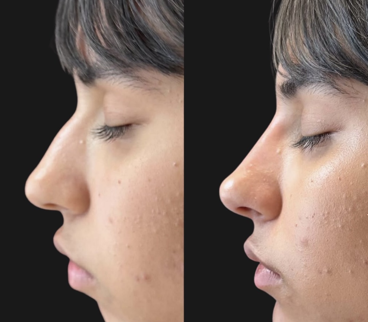 rhinoplasty Patient 16