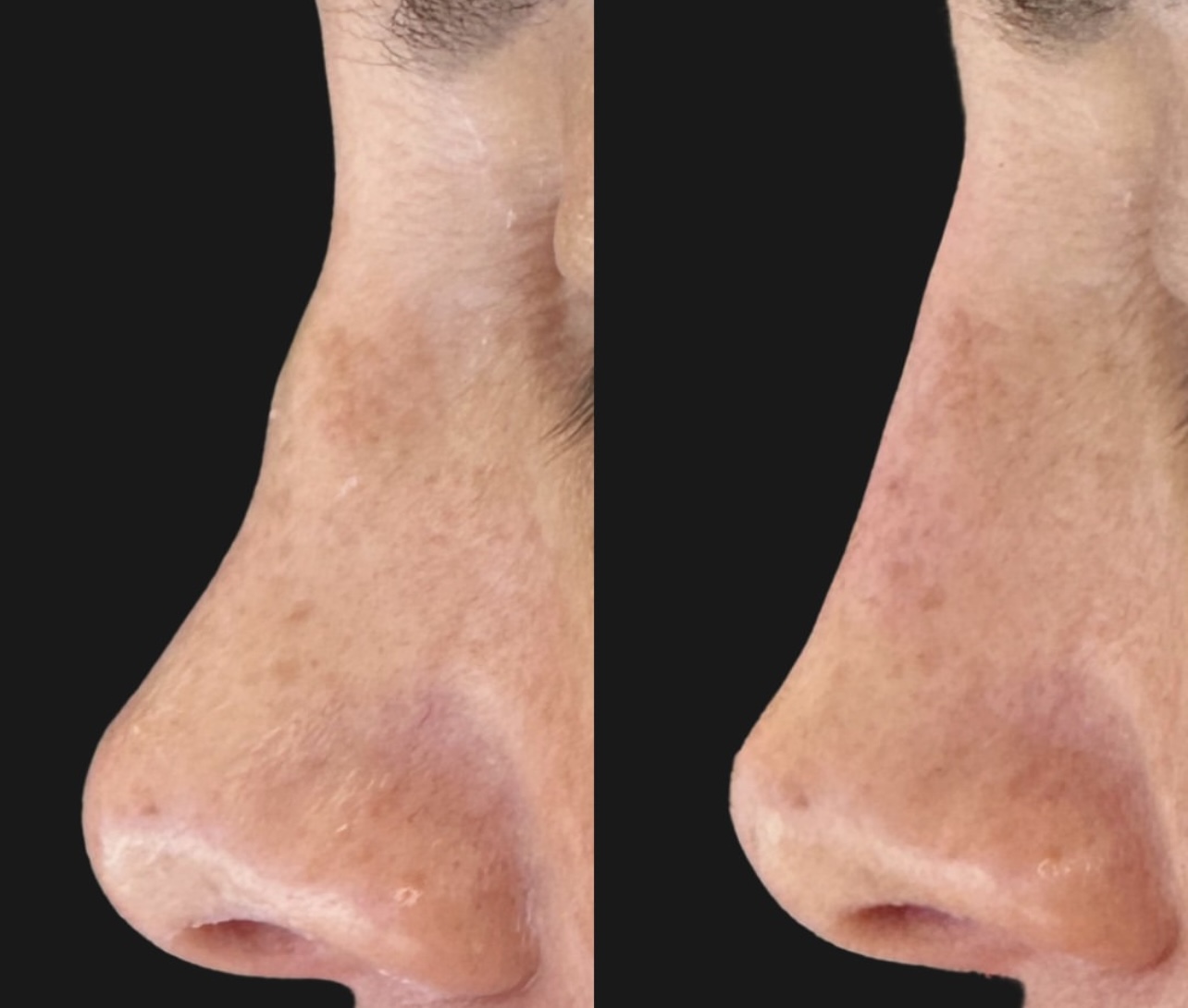 rhinoplasty Patient 15