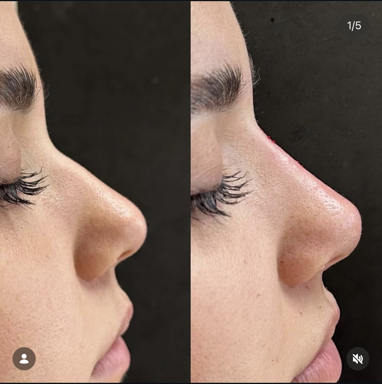 rhinoplasty Patient 10
