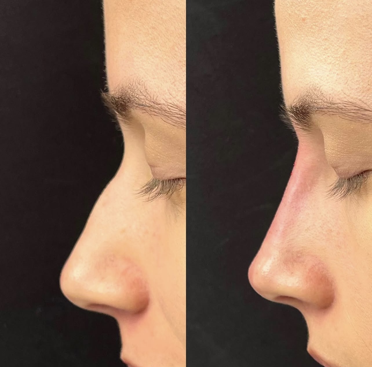 rhinoplasty Patient 2