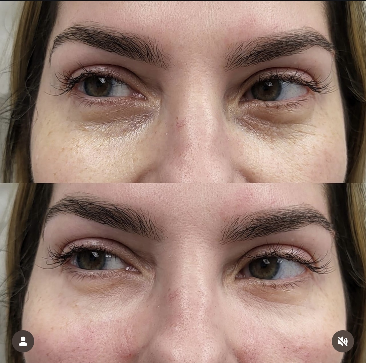 under-eye-correction Patient 12