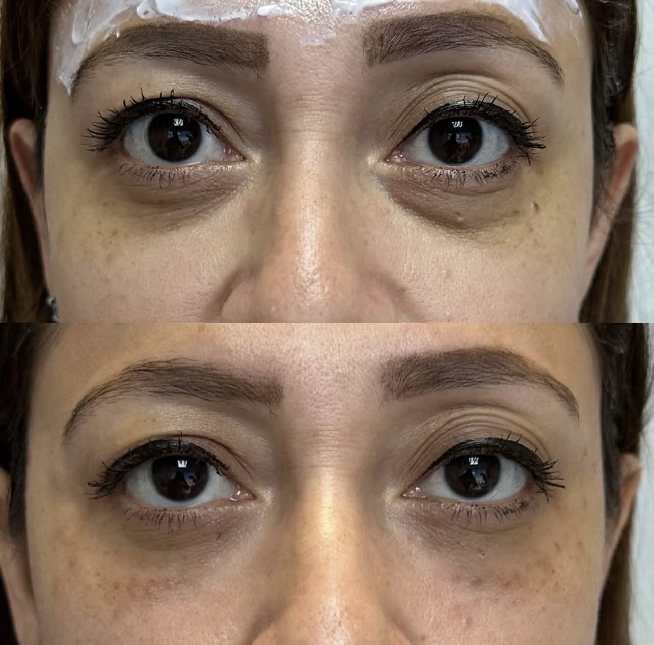 under-eye-correction Patient 11