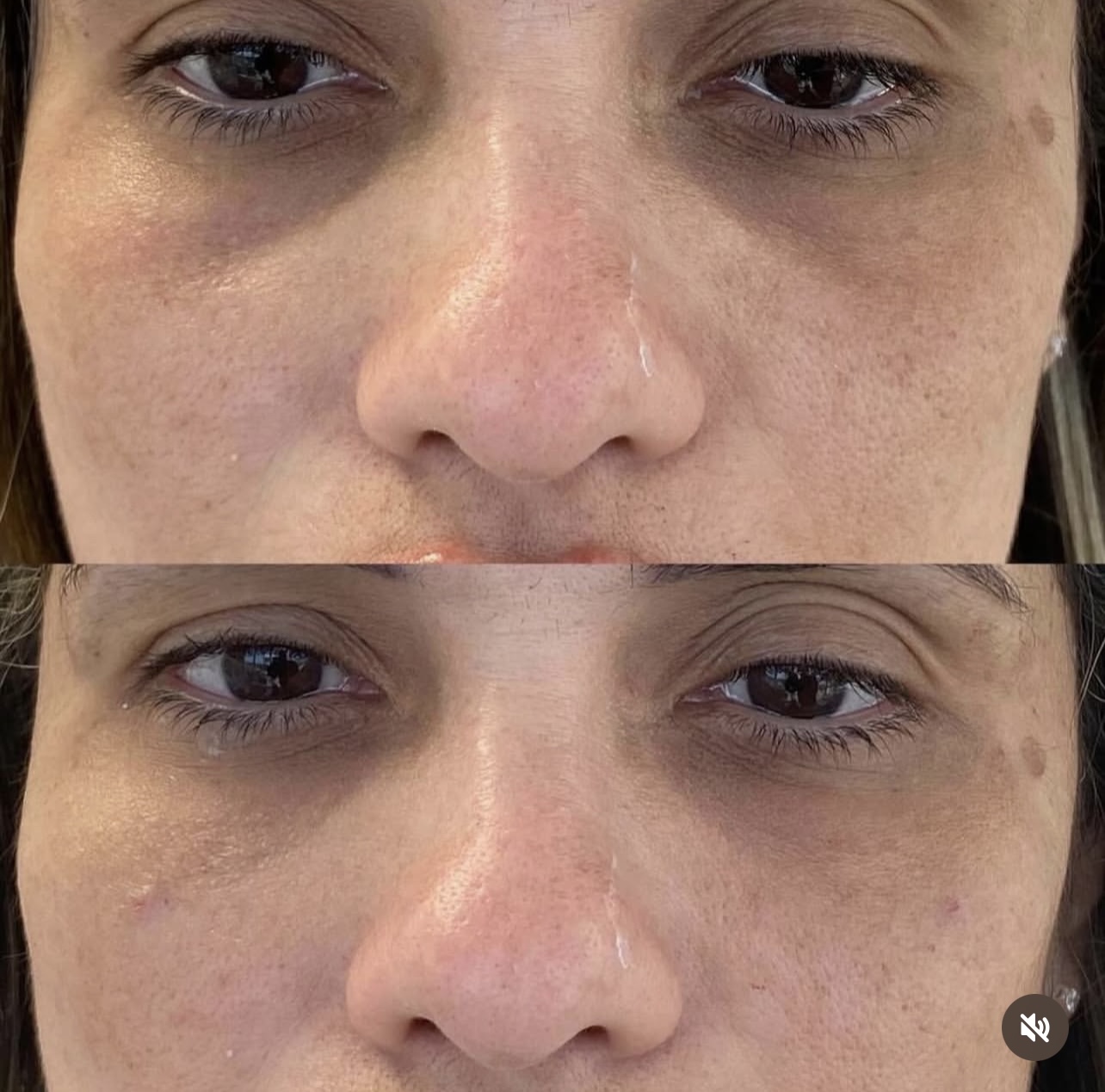 under-eye-correction Patient 9