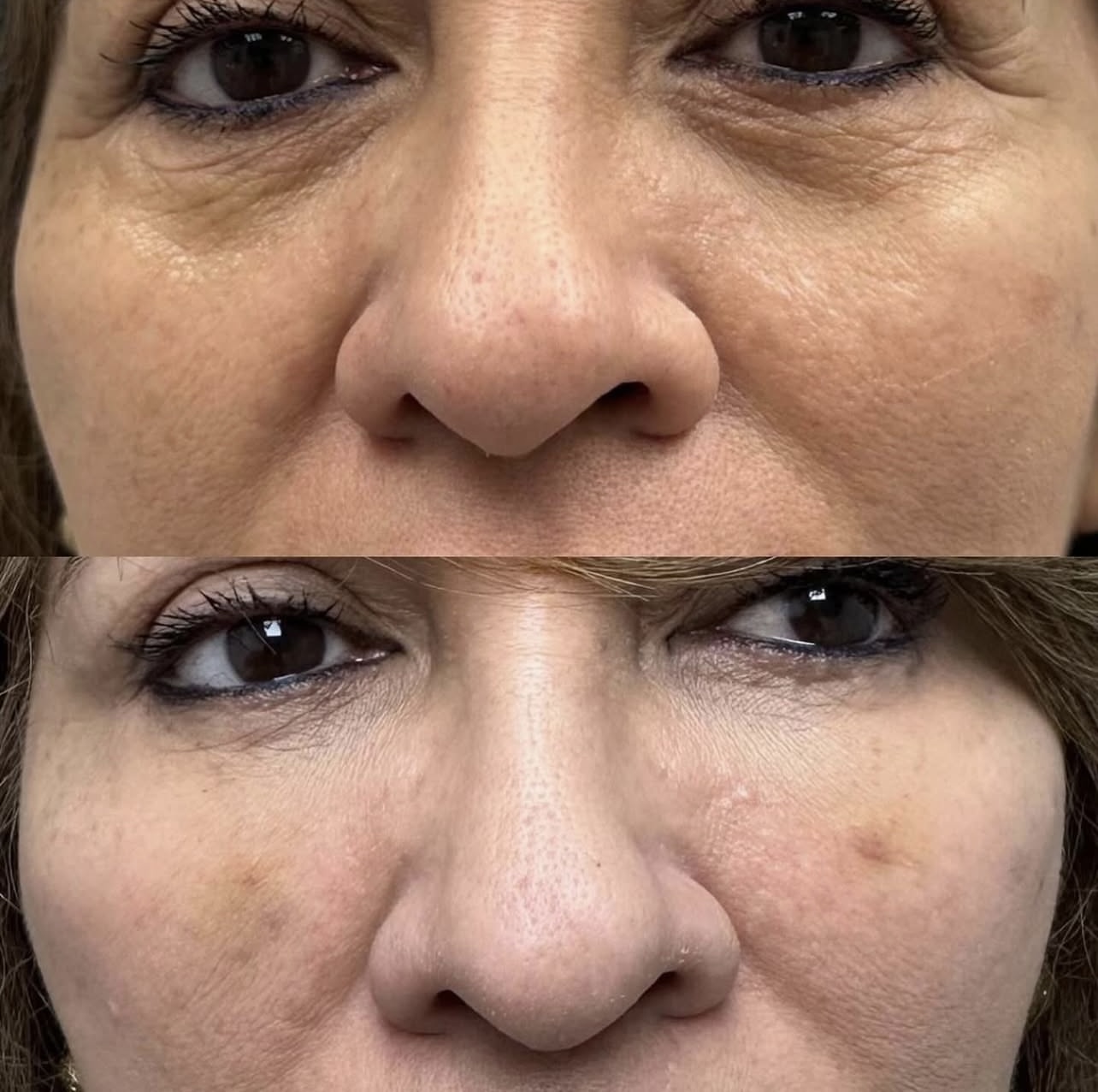 under-eye-correction Patient 7