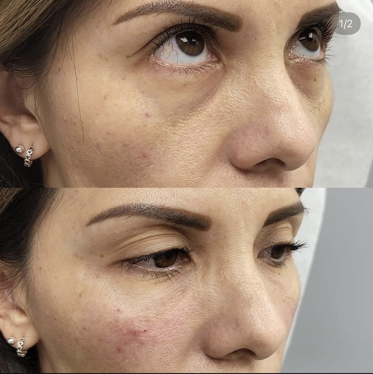 under-eye-correction Patient 6