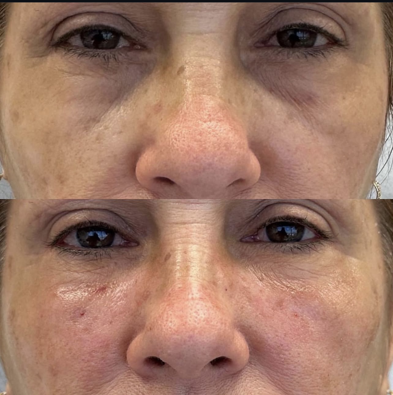 under-eye-correction Patient 5