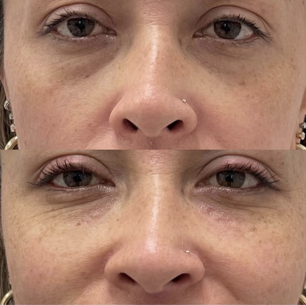 under-eye-correction Patient 2