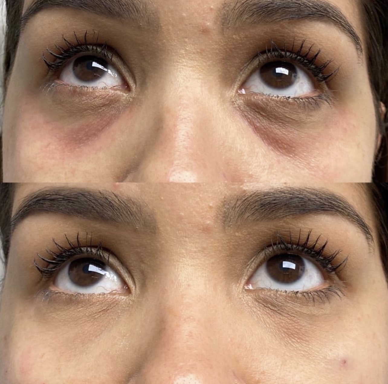 under-eye-correction Patient 1
