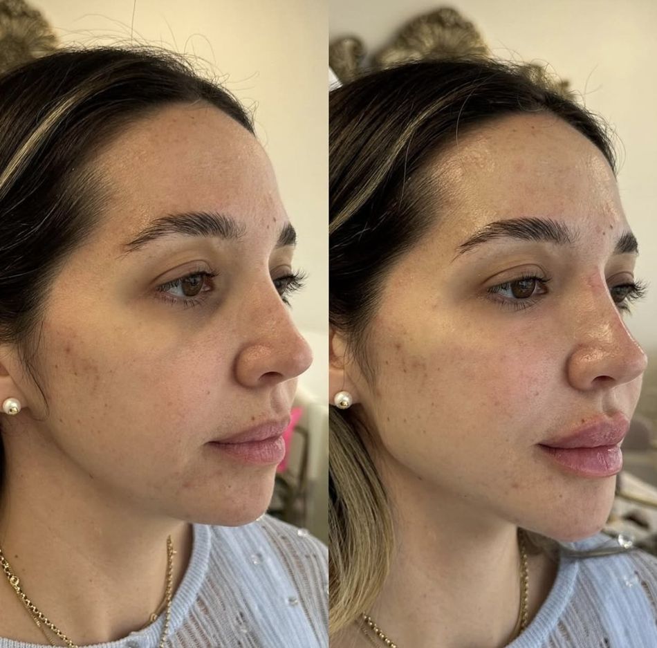 Cara de Ozempic en Miami: Cómo Arreglarla | Yeny Liscano MedSpa